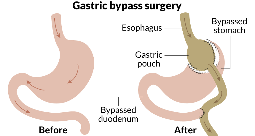 021517_lb_gastric-bypass_free