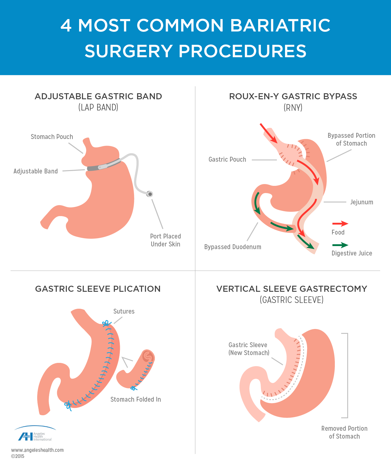 weightlosssurgery-diagram